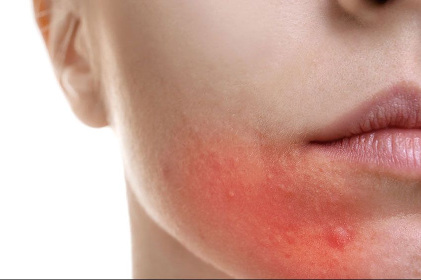 Cera naczynkowa i trądzik różowaty – łagodne zabiegi kosmetologiczne Vital Skin w Warszawie