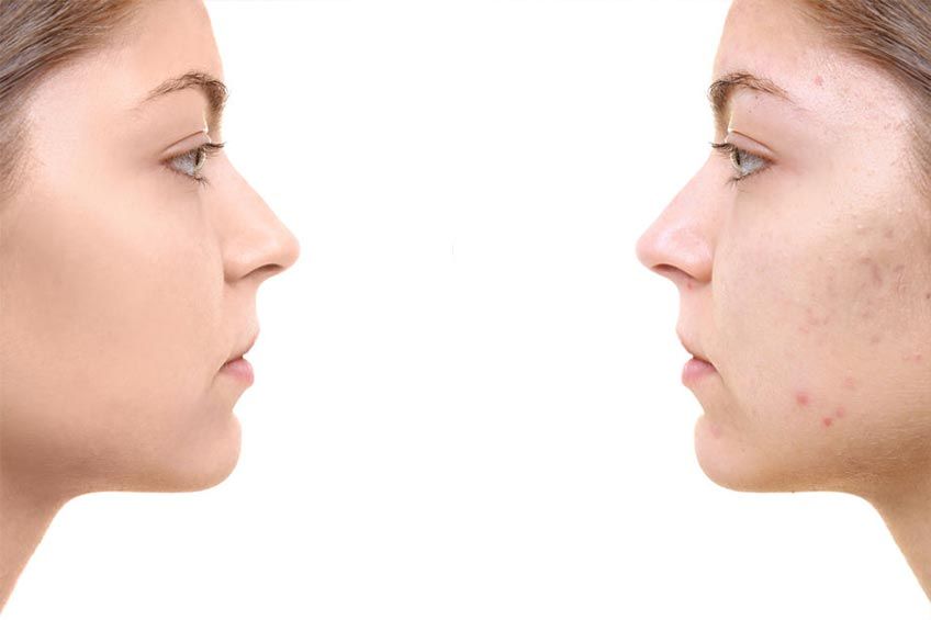 Skóra problematyczna i trądzikowa – zabiegi kosmetologiczne Vital Skin w Warszawie